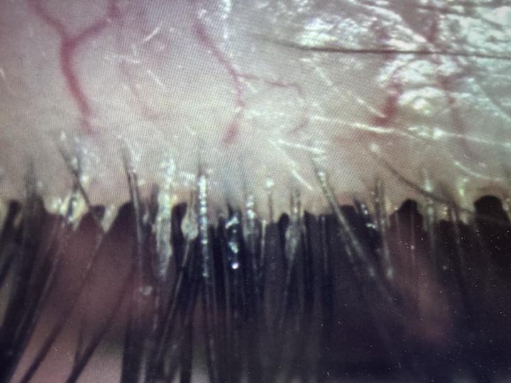 Clsoe up of blepharitis encrusted eyelashes